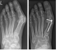 Hallux